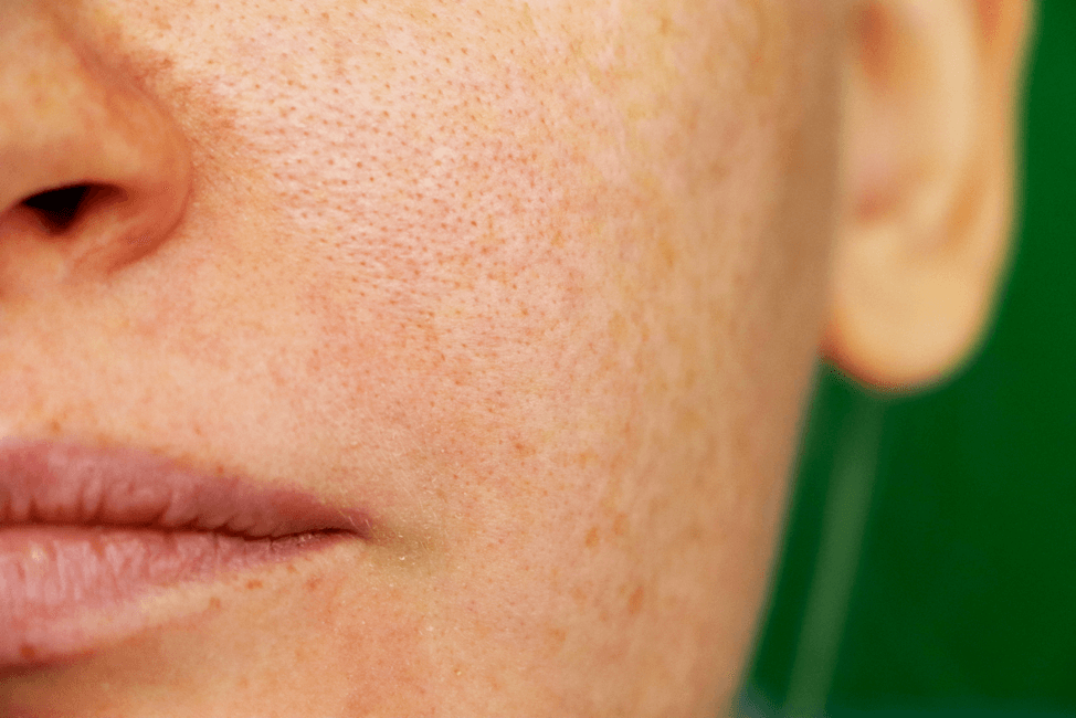 hyperpigmentation