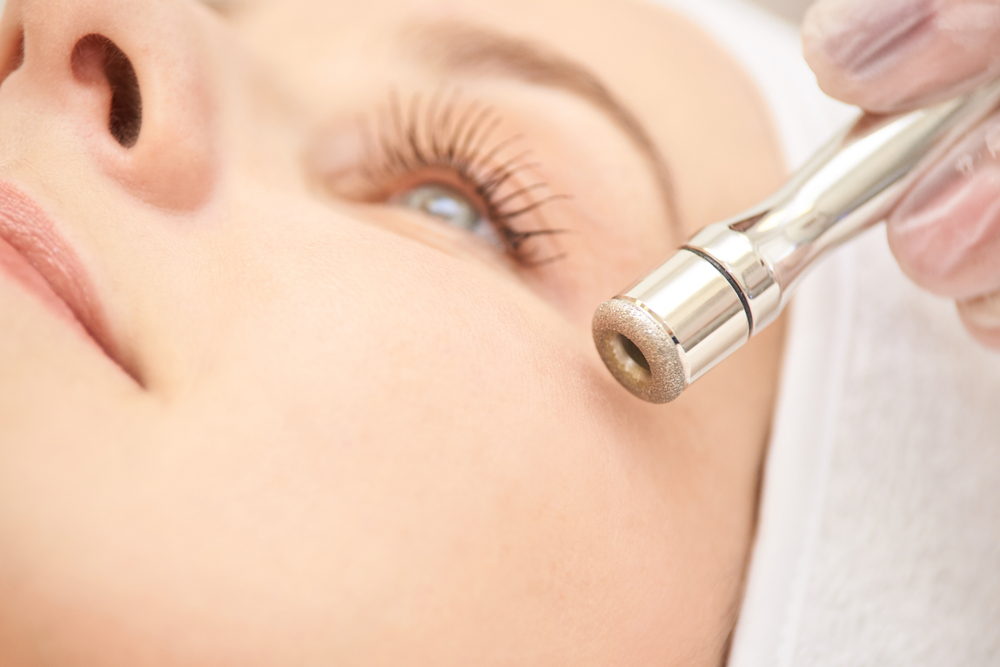 microdermabrasion for hyperpigmentation