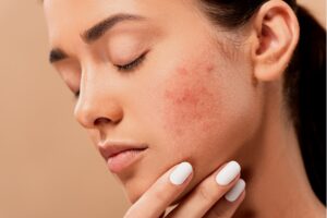 hormonal change has a effect on your skin